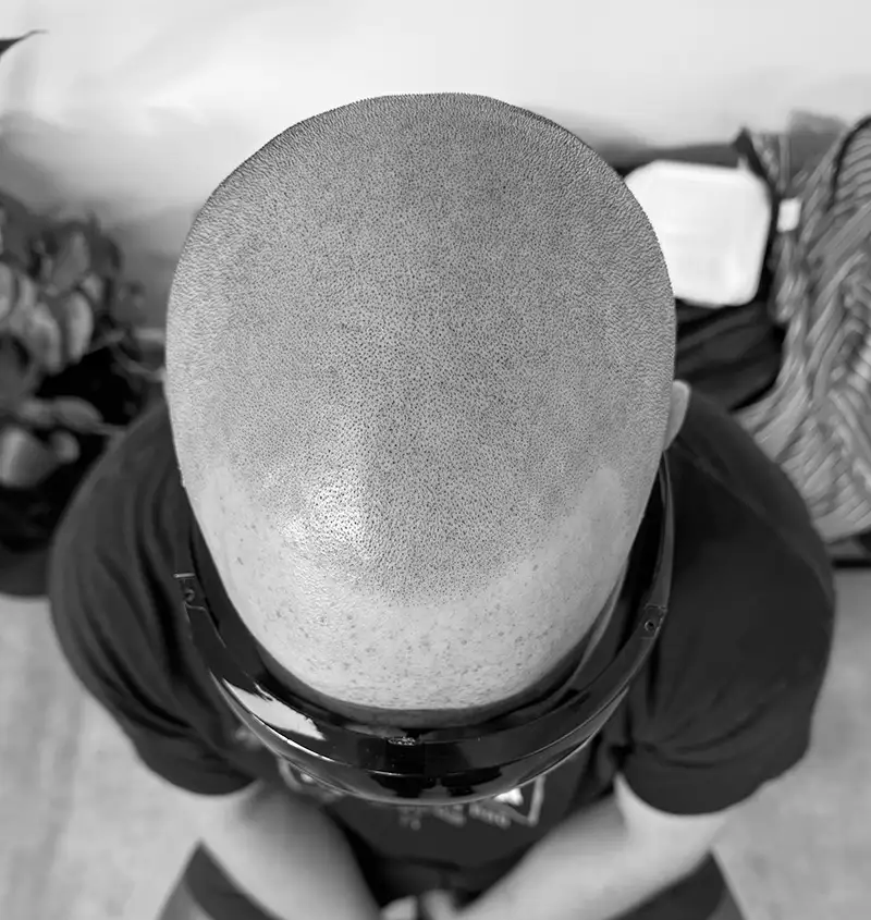 scalp micropigmentation artist