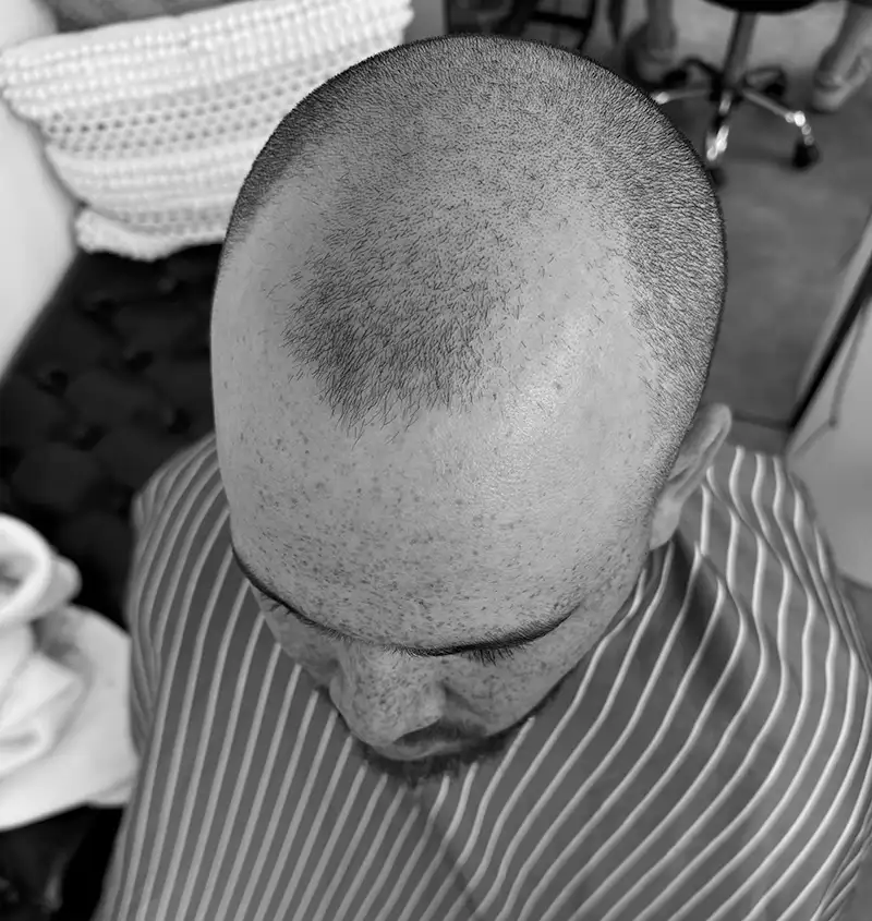 scalp micropigmentation cost nz