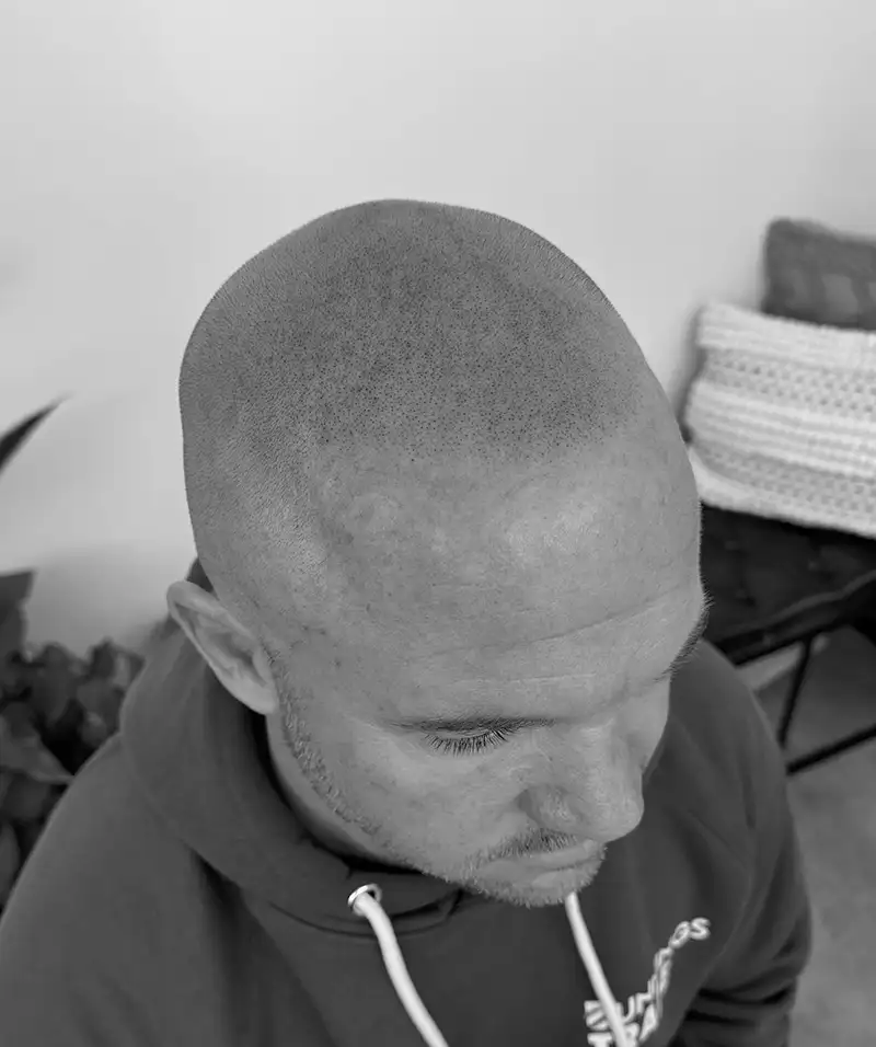 scalp micropigmentation results