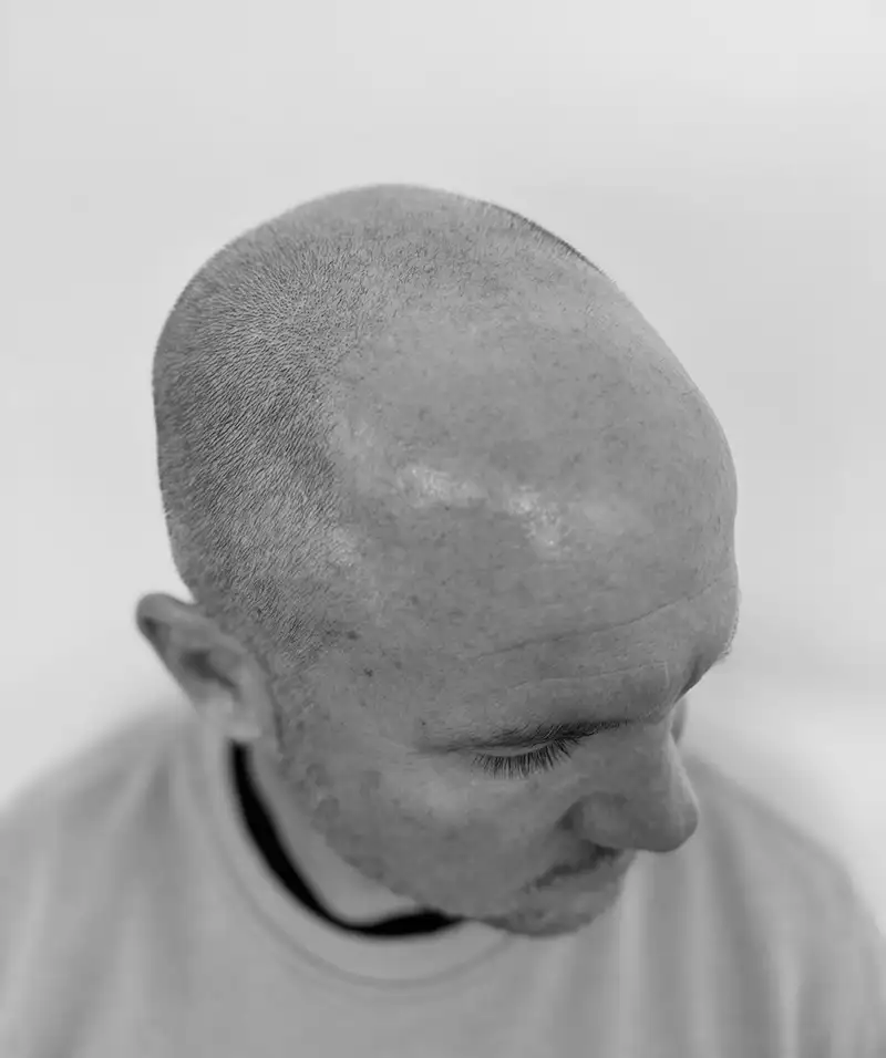 scalp micropigmentation treatment