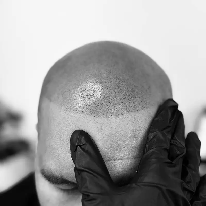 scalp tattooing